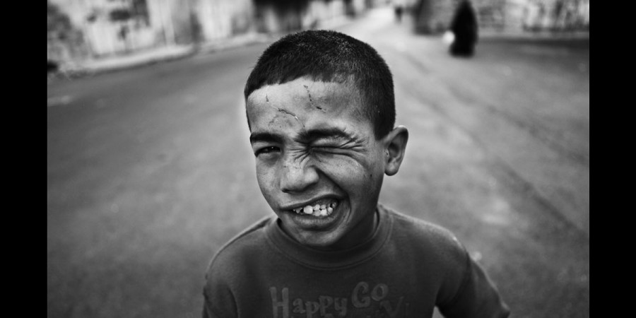 A child is scarred from confrontations with settlers in the Old City in Khalil. ©Youssef Sharkana